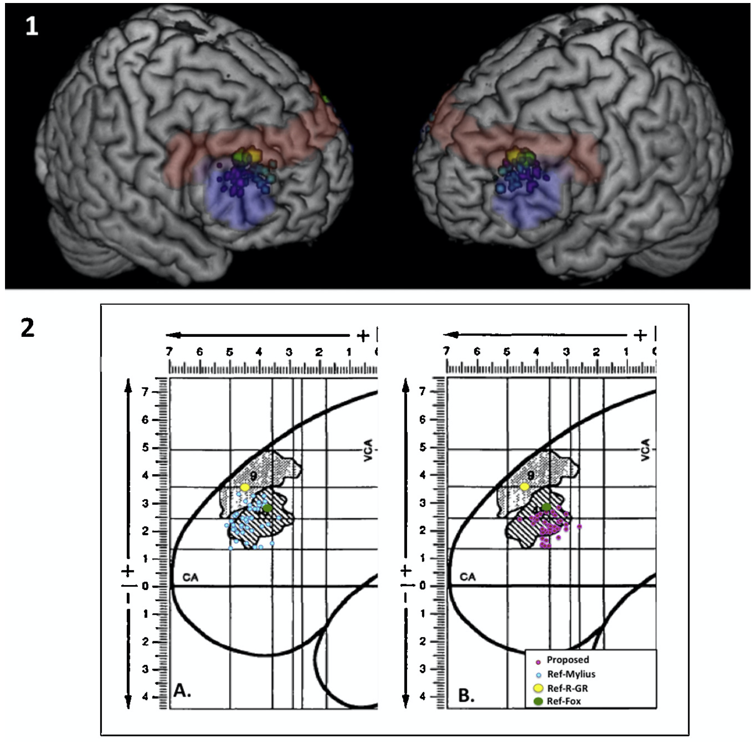 Localisation du DLPFC selon différentes méthodes pour la stimulation rTMS