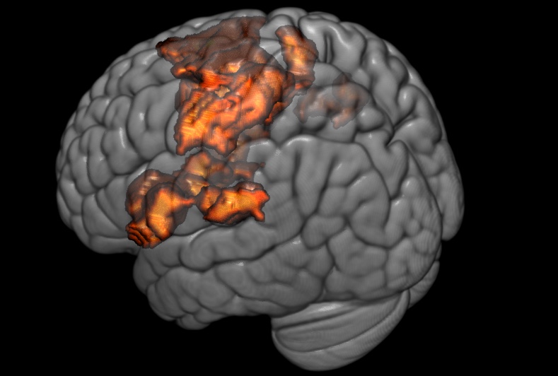 projection des activations pendant la douleur à la surface d'un cerveau 