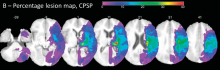 percentage lesion map of painful patients: Thalamus and white matter